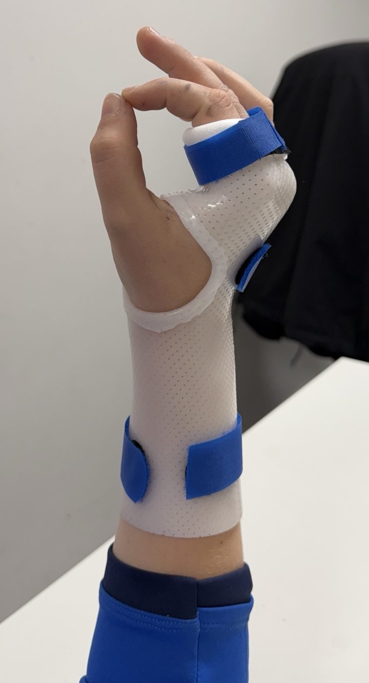 Orthèse thermoformée perforée d'immobilisation pour fracture des 4e et 5e métacarpiens, articulations métacarpophalangiennes en flexion