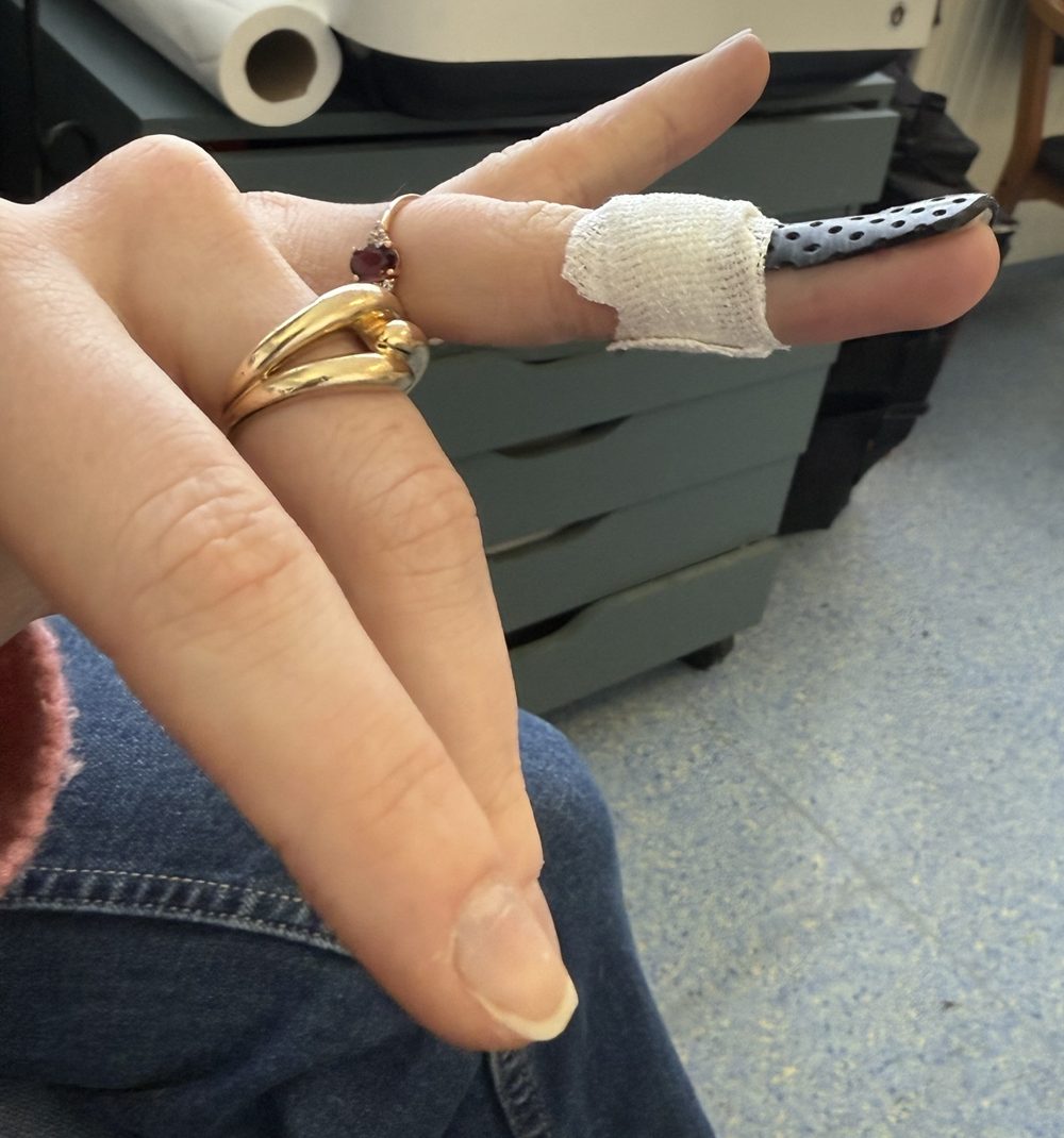 Orthèse collée pour mallet finger